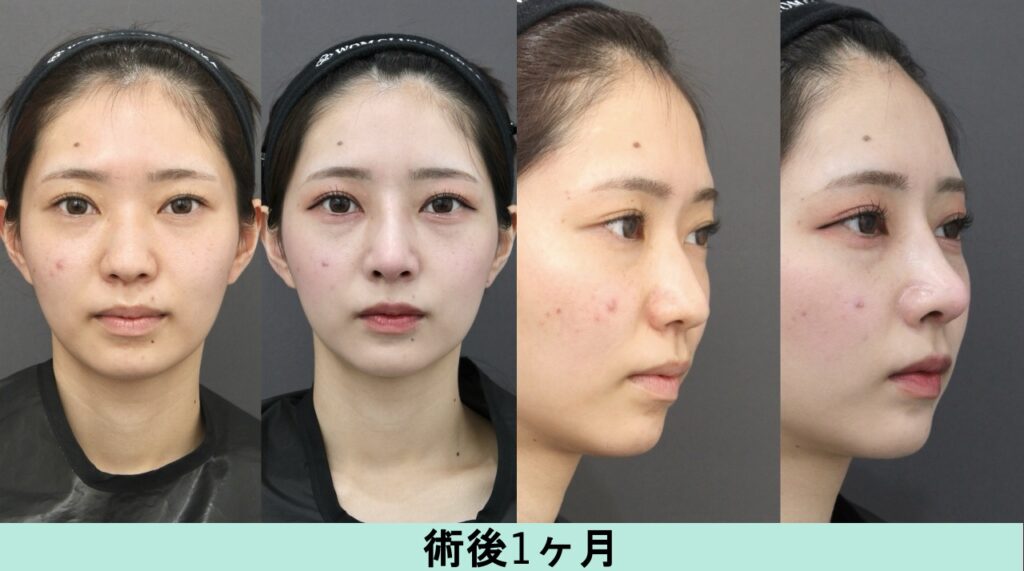 『自家組織による立体感アップ&バランス改善』の画像