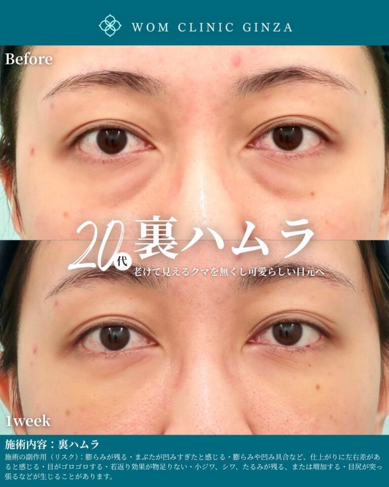 裏ハムラ法のビフォーアフター