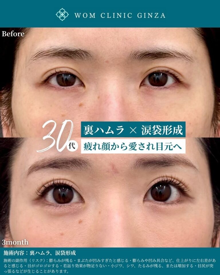 裏ハムラと涙袋形成のビフォーアフター