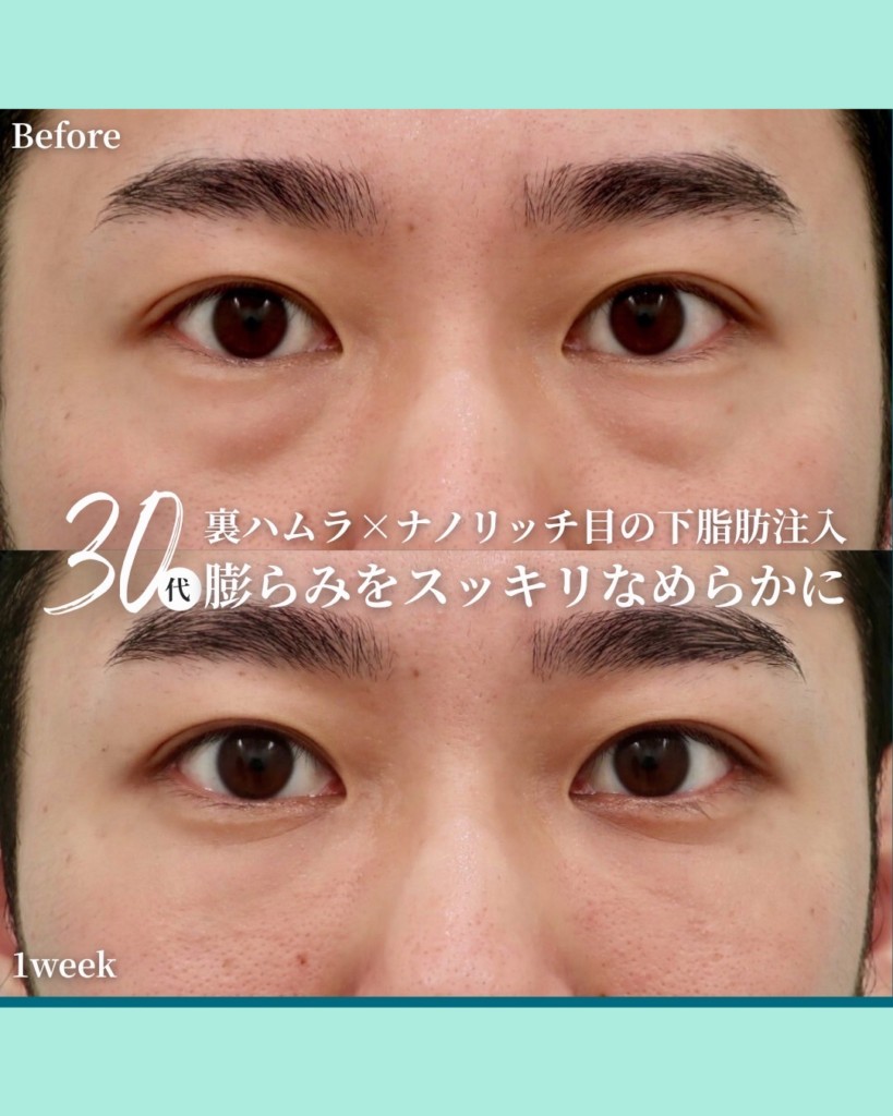 裏ハムラ法と脂肪注入のビフォーアフター