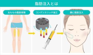 脂肪注入の施術工程のイラスト
