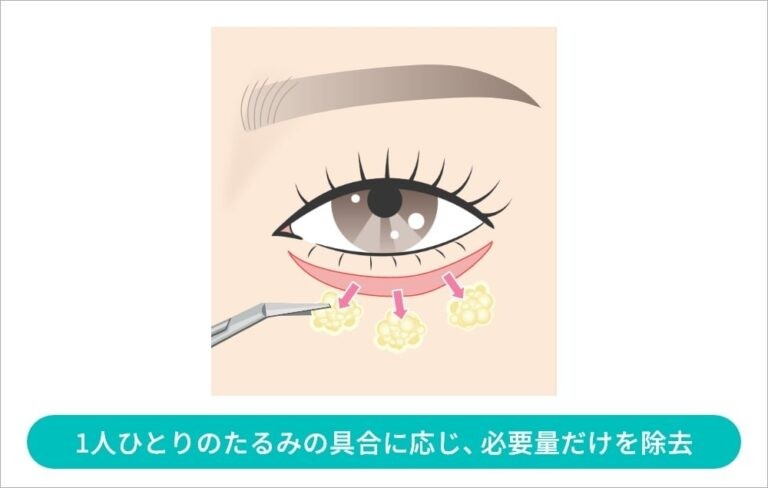 目の下脂肪取りの施術箇所