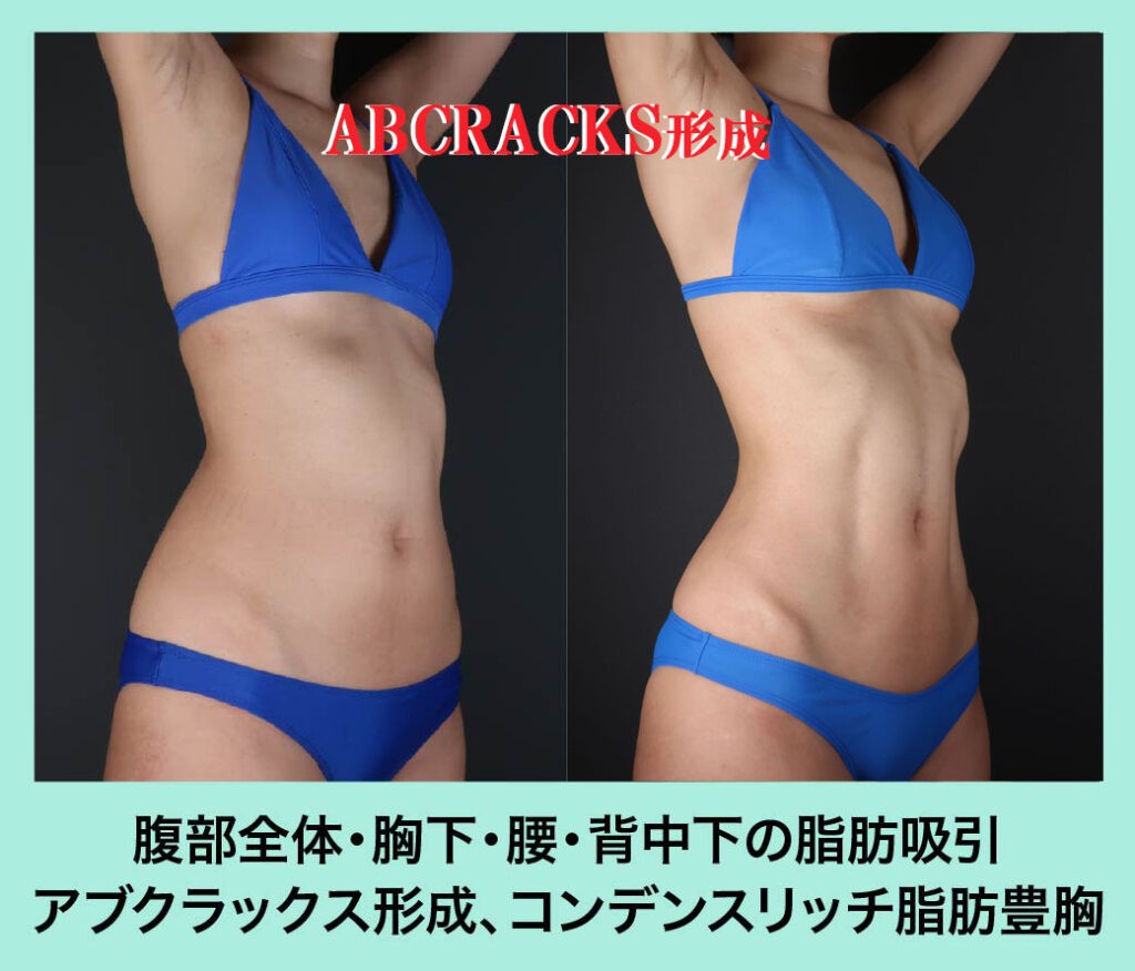 腹部脂肪吸引とアブクラックス形成のビフォーアフター