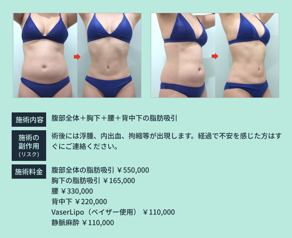 お腹の脂肪吸引のビフォーアフター