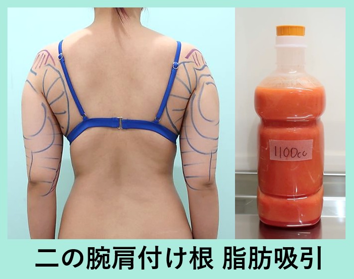 二の腕肩付け根の脂肪吸引と除去された脂肪