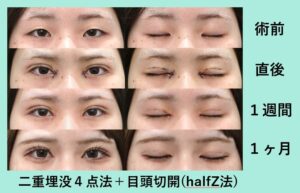 埋没法+目頭切開の症例写真