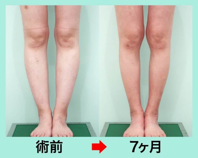ふくらはぎと前スネ脂肪吸引のビフォーアフター
