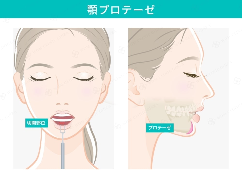 顎プロテーゼ