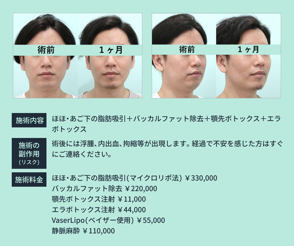 小顔治療の併用のビフォーアフター