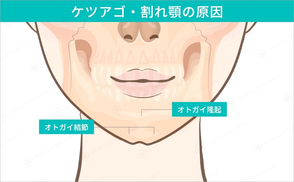 ケツアゴ・割れ顎の原因