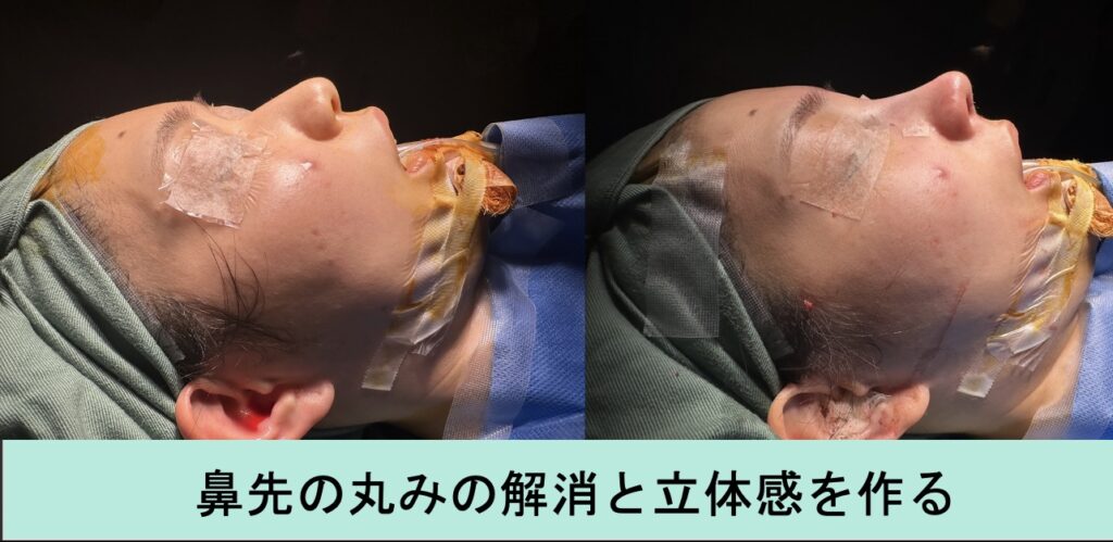 『自家組織による立体感アップ&バランス改善』の画像
