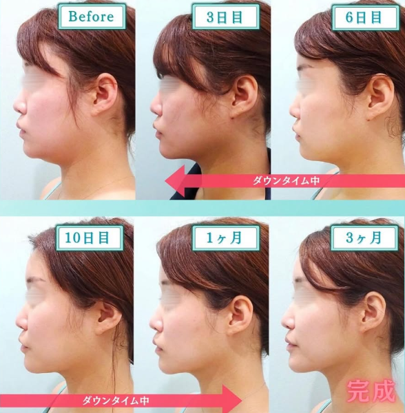 顔の脂肪吸引のダウンタイム経過