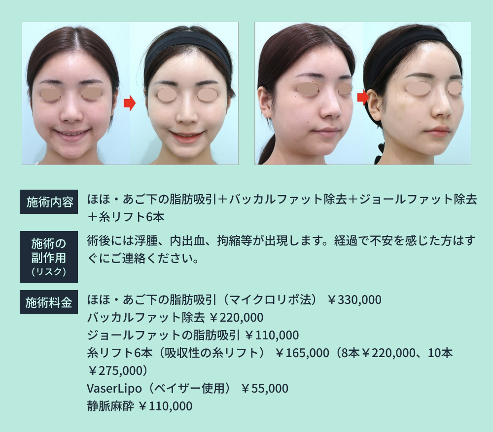 脂肪吸引のビフォーアフター