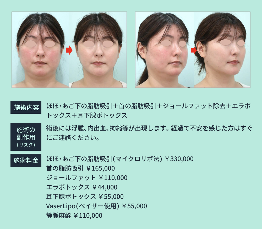 脂肪吸引とボトックス施術のビフォーアフター