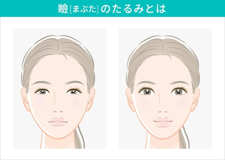 瞼のたるみの原因とは？改善方法や予防方法、おすすめの美容施術を解説