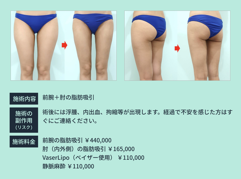 太ももの脂肪吸引のビフォーアフター
