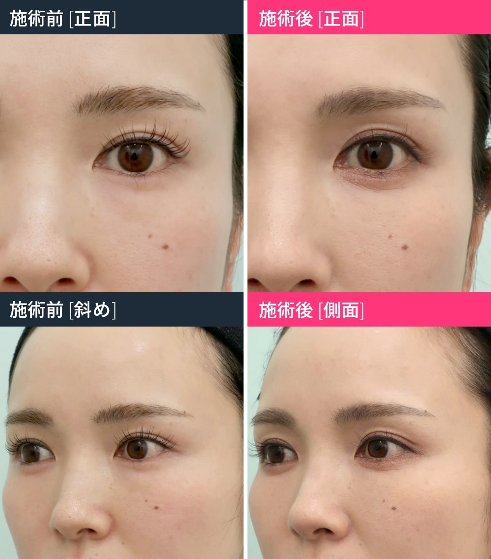 裏ハムラ法 修正施術