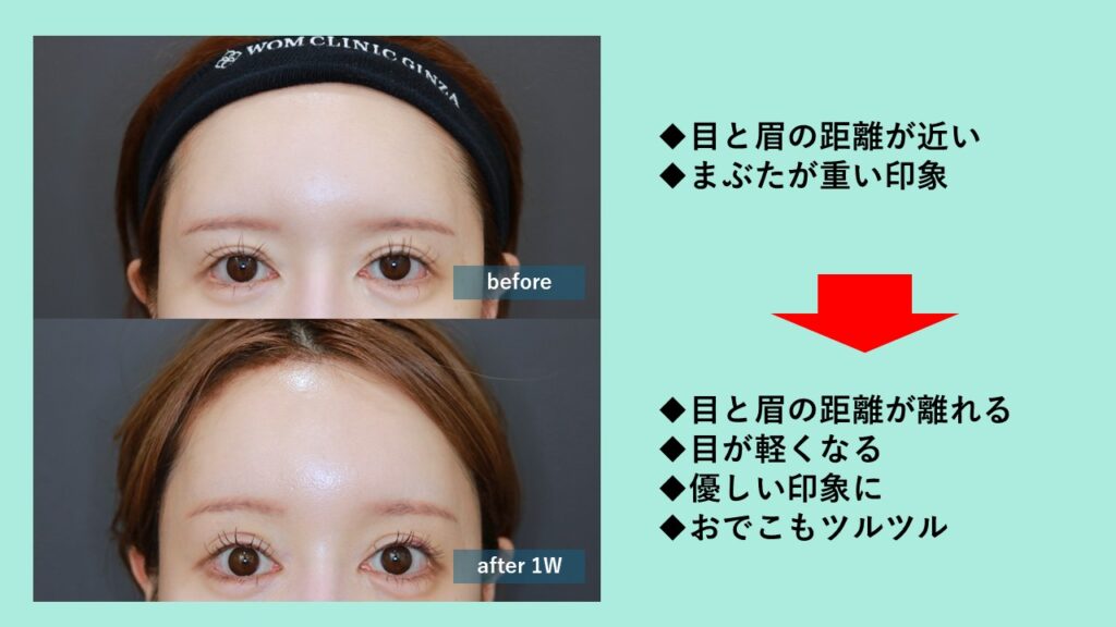 『爆美女をつくる内視鏡額挙上』の画像
