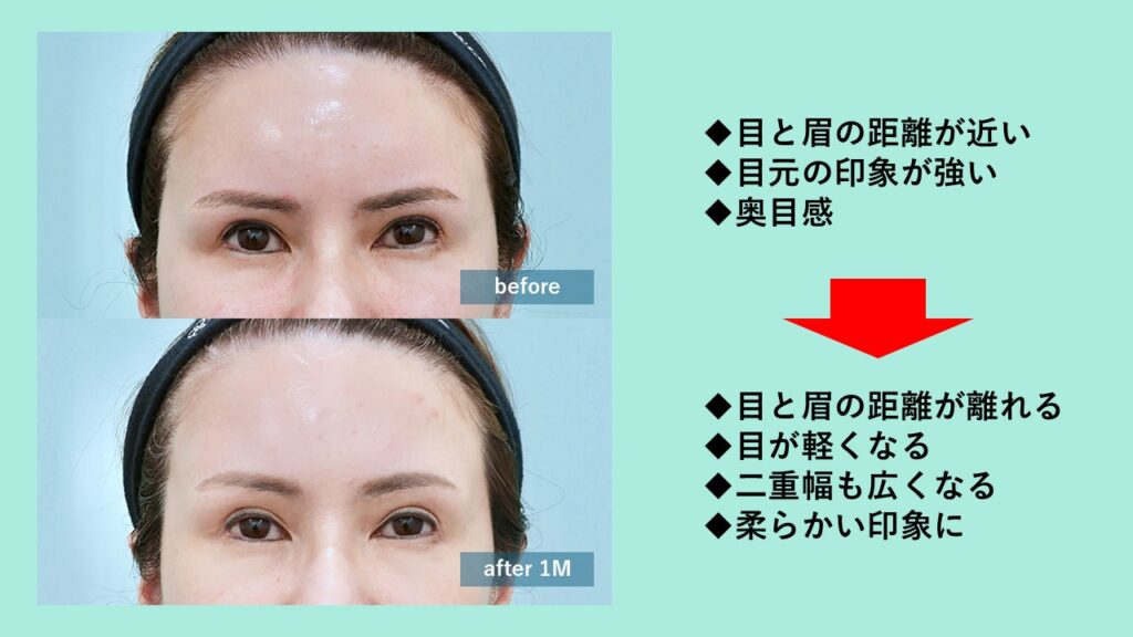 『眉下切開後に“怖く見える”?額挙上で解決』の画像