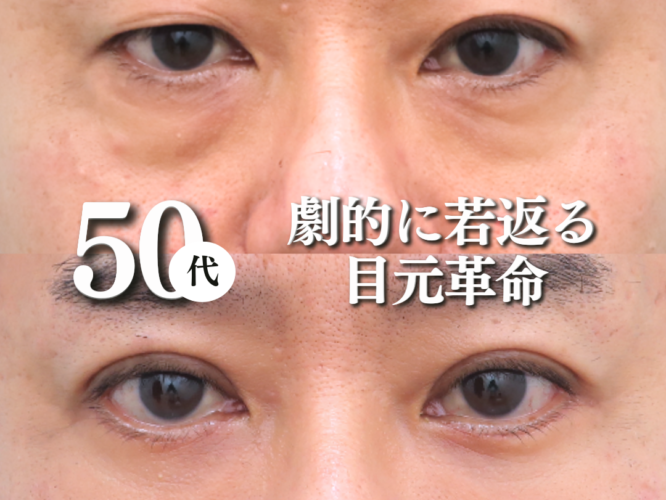 切開ハムラ、埋没法
