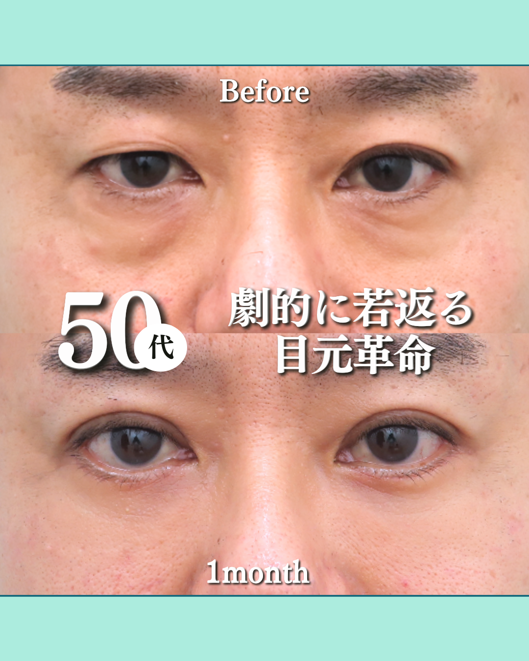 切開ハムラ、埋没法