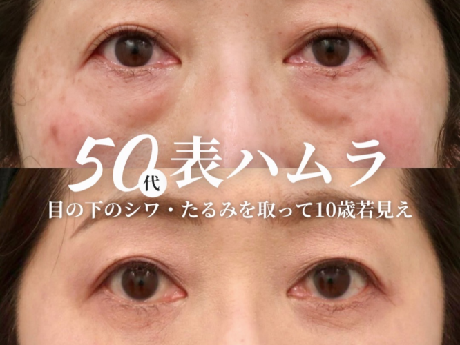 表ハムラ