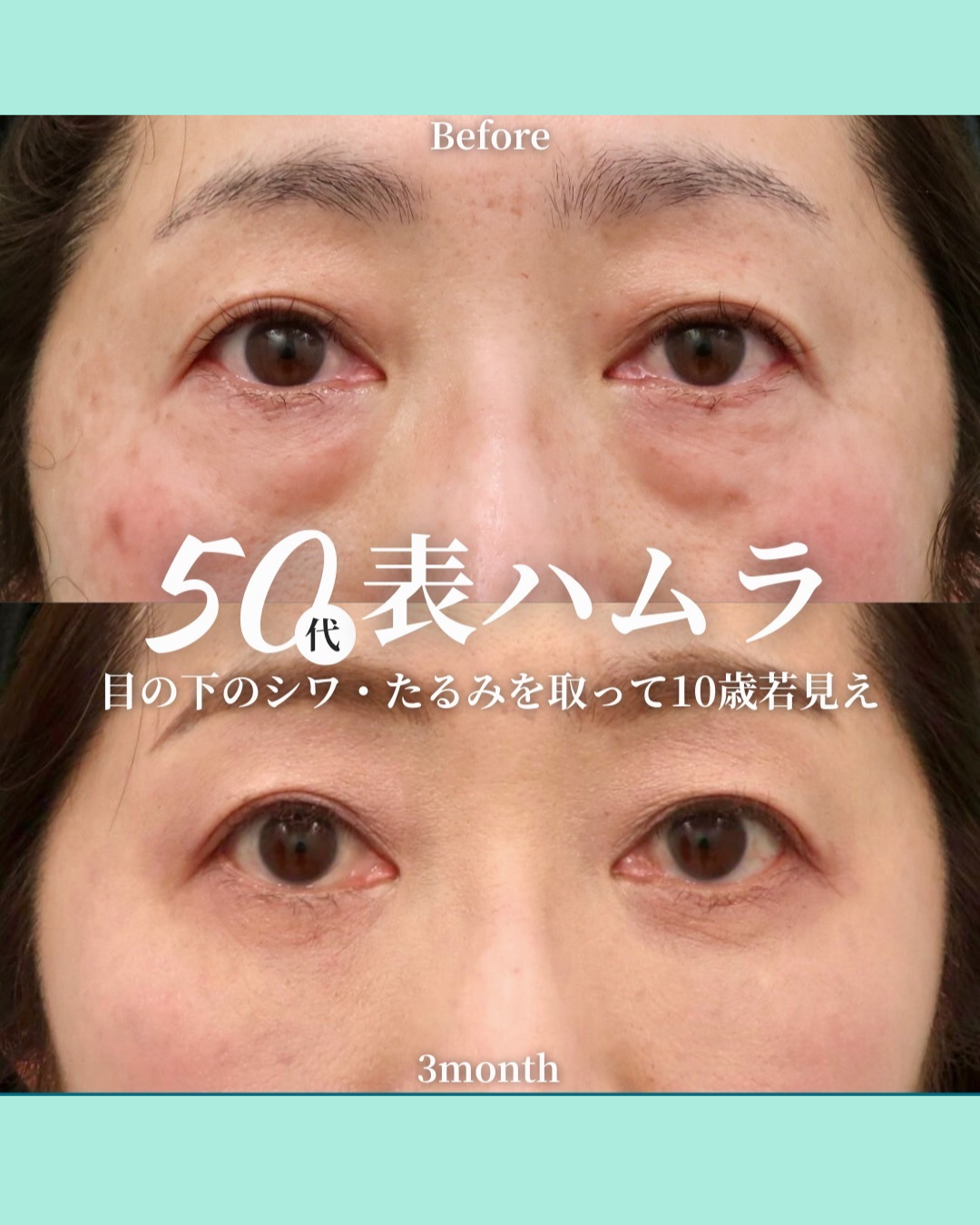 表ハムラ