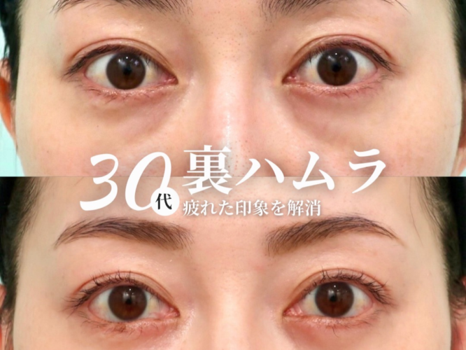 裏ハムラ、糸リフト