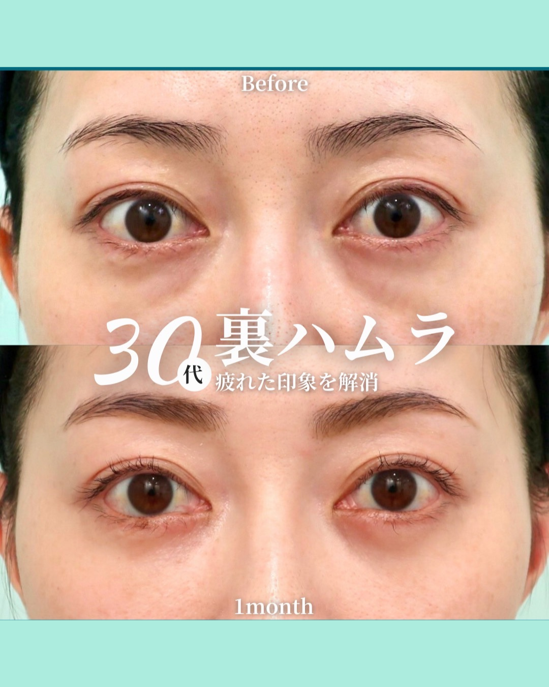 裏ハムラ、糸リフト