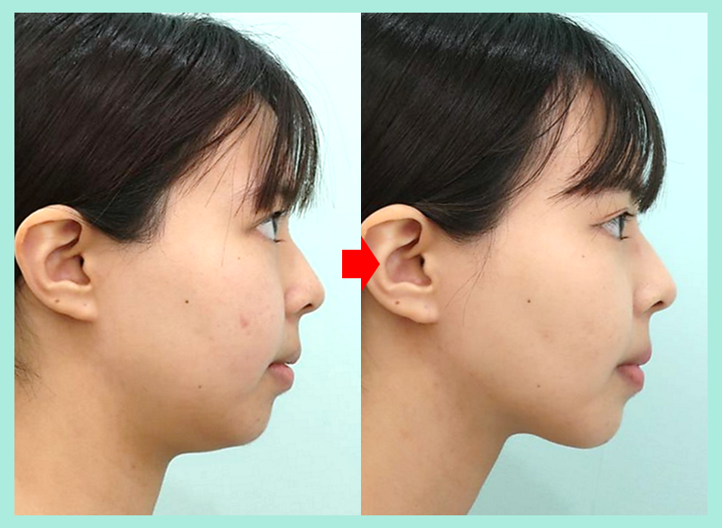 パリっとした横顔に変化した症例