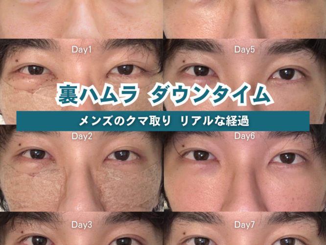裏ハムラ法、涙袋、ダウンタイム