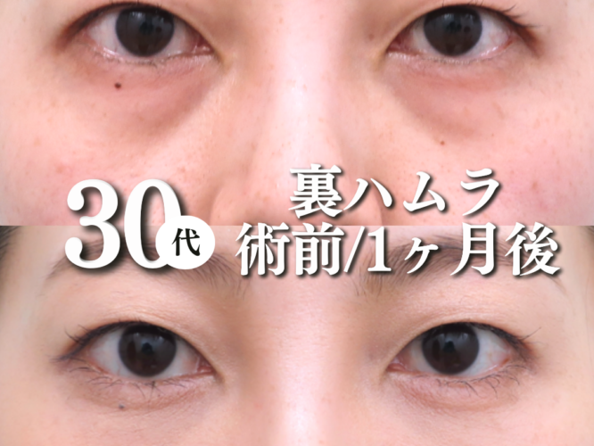 裏ハムラ法、八の字クマ