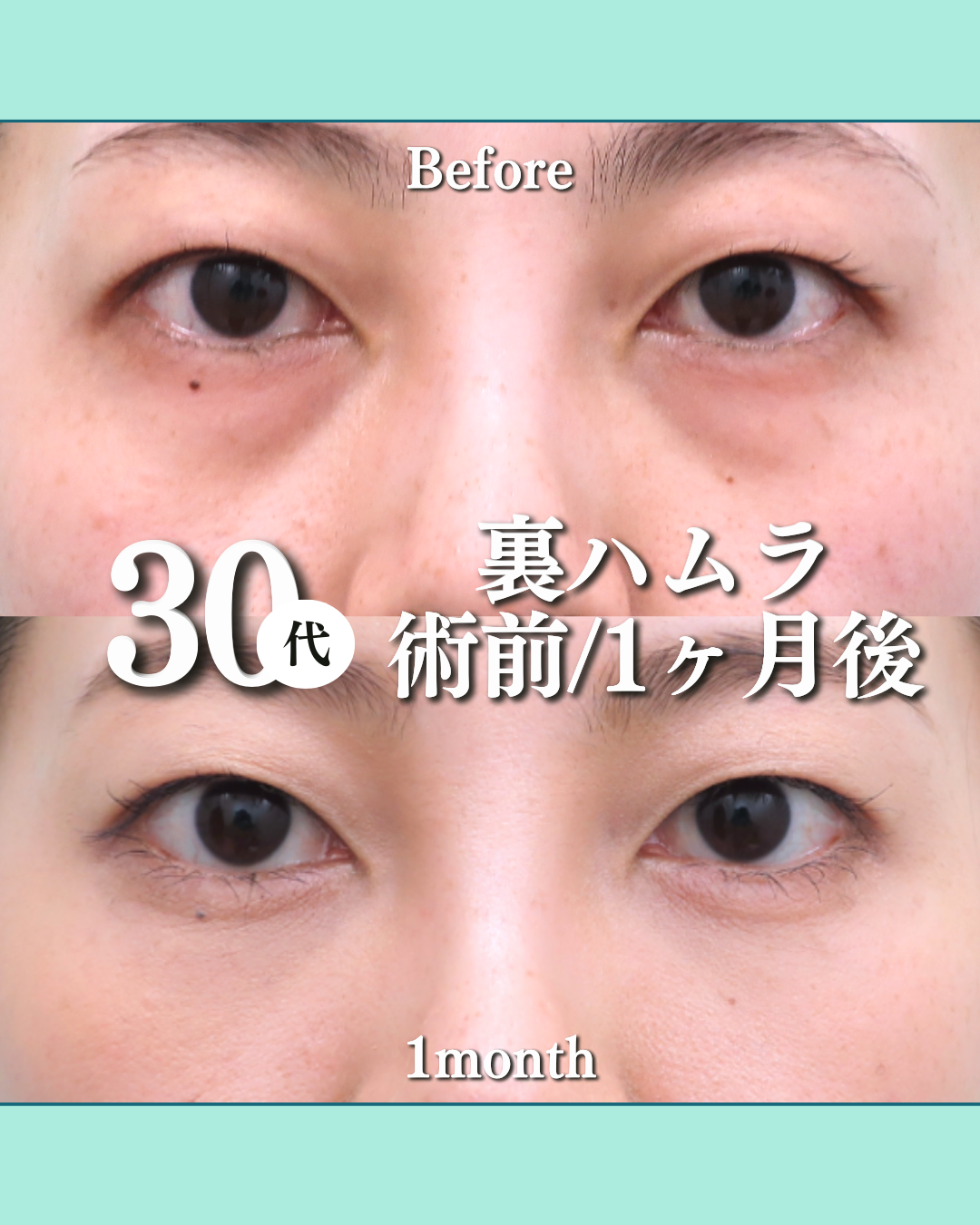 裏ハムラ法、八の字クマ