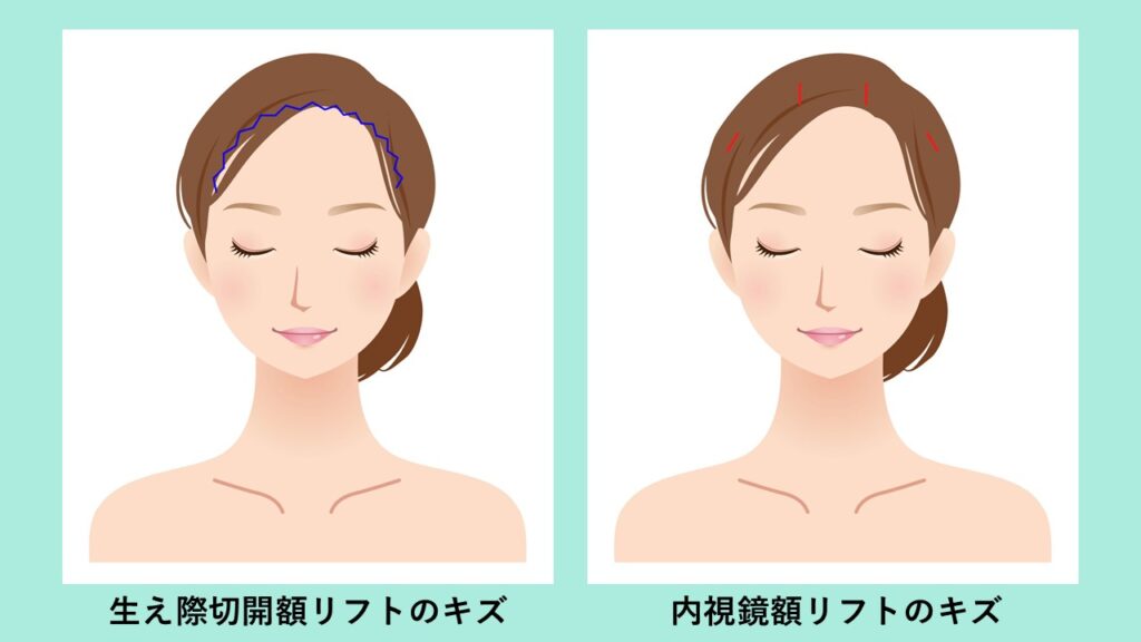『眉下切開後に“怖く見える”?額挙上で解決』の画像