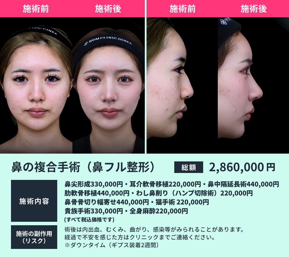 鼻フル整形のビフォーアフター02
