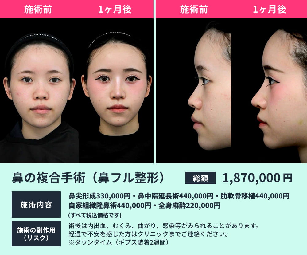 鼻フル整形のビフォーアフター03