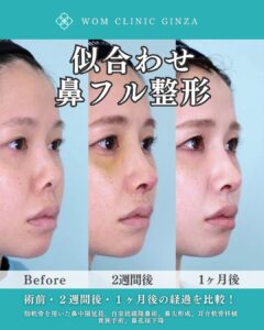 似合わせ鼻フル整形 症例写真