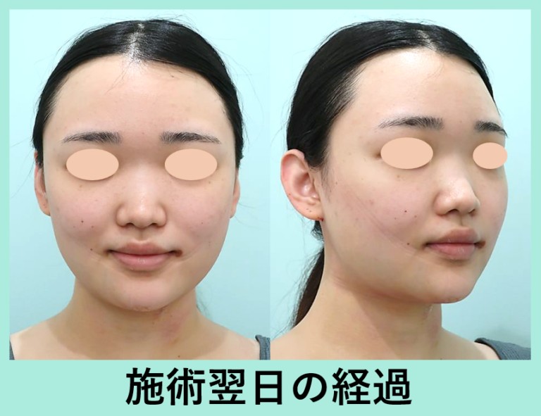 術後翌日｜多めの脂肪を吸引したケースの症例