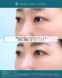 裏ハムラ法の症例写真2
