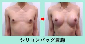 シリコンバッグ豊胸の症例写真