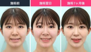 頬・顎下の脂肪吸引の症例写真