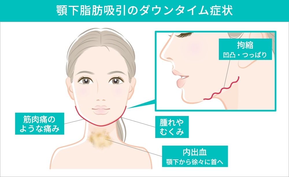 顎下脂肪吸引のダウンタイム症状