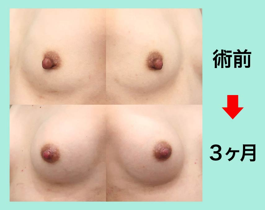 『『 乳頭形成 + シリコンバッグ豊胸 』で完成度の高い胸を作る』の画像