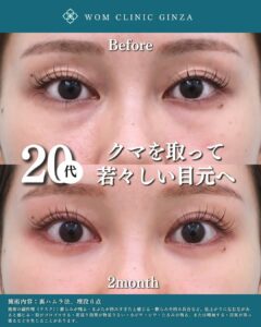 20代 裏ハムラ法+埋没6点の症例写真