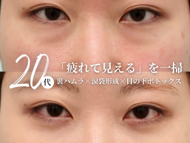 裏ハムラ　涙袋形成