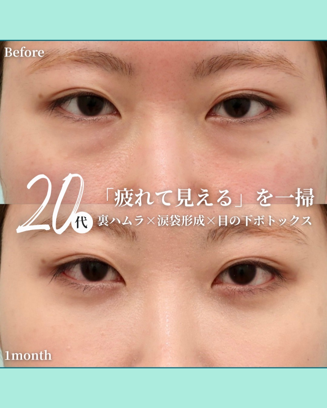裏ハムラ 涙袋形成