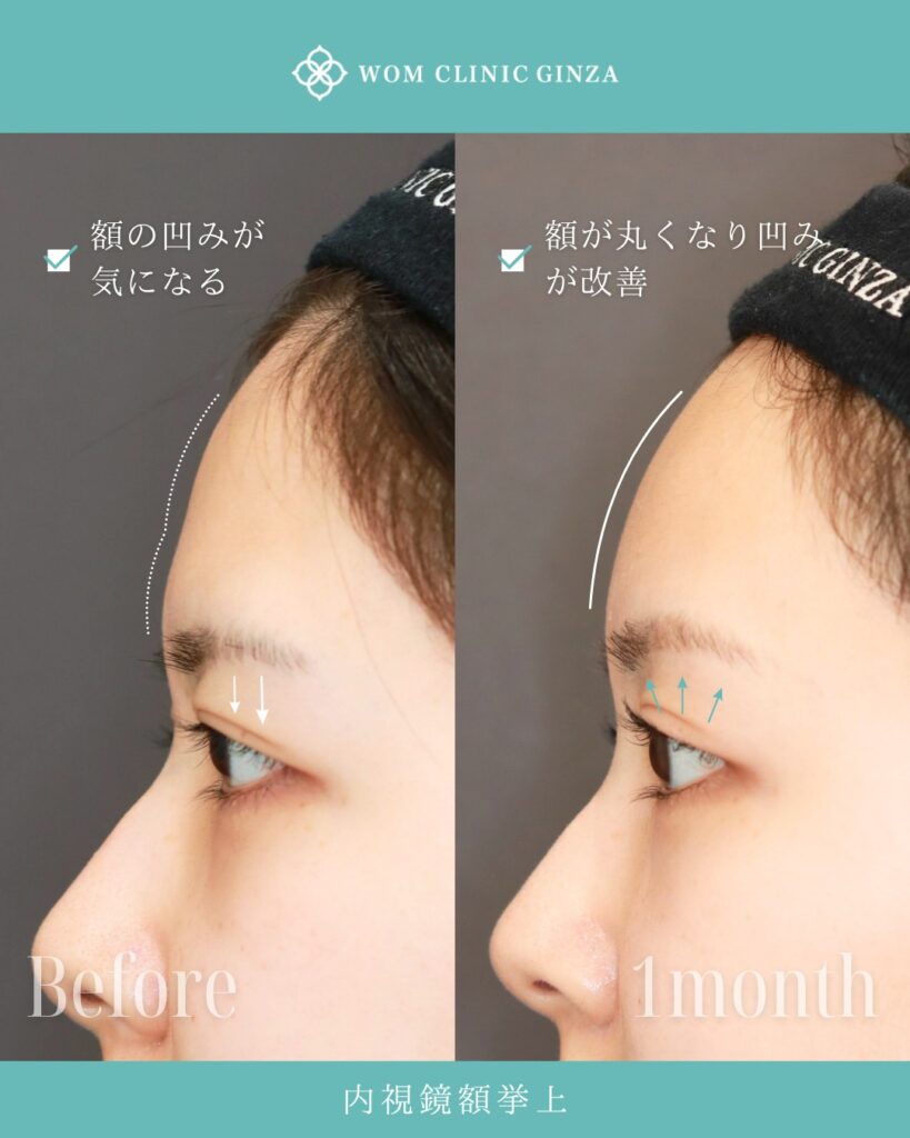 『目元の印象は“上顔面”で決まる:内視鏡額挙上で叶える”愛され顔”』の画像