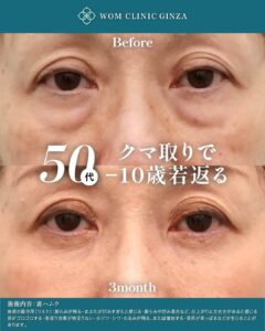 50代 裏ハムラ法の症例写真