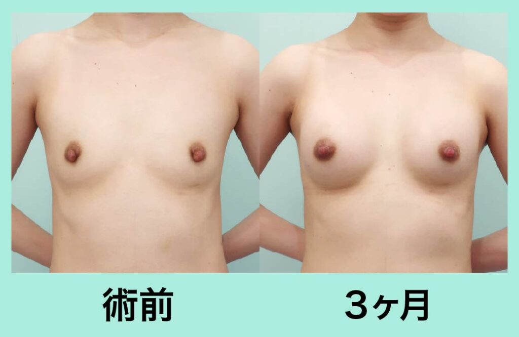 『『 乳頭形成 + シリコンバッグ豊胸 』で完成度の高い胸を作る』の画像