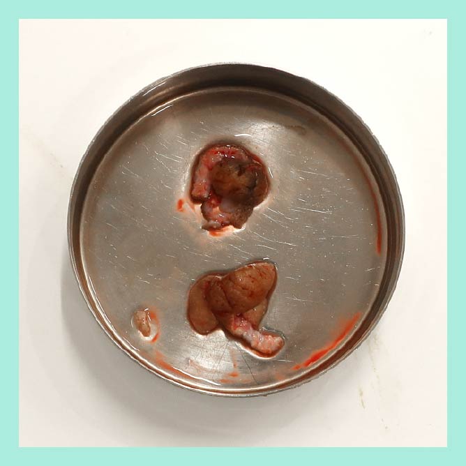 『『 乳頭形成 + シリコンバッグ豊胸 』で完成度の高い胸を作る』の画像